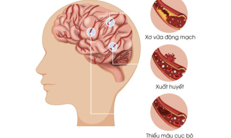 Triệu Chứng Đột Quỵ Nhẹ: Nguyên Nhân, Chẩn Đoán Và Phòng Ngừa